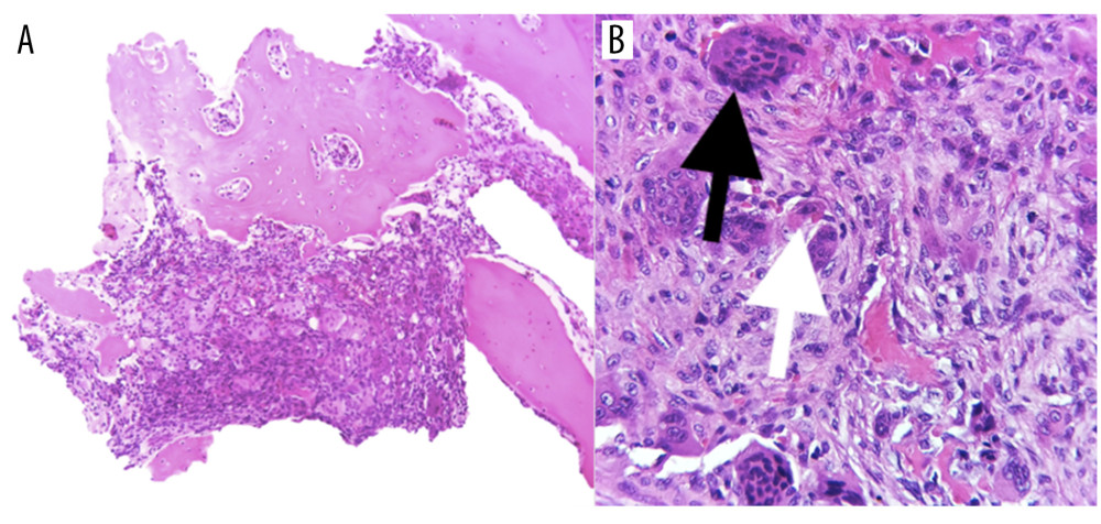 Tumor biopsy. (A) Giant cell tumor of bone. Cortical bone is eroded by osteoclasts and partially surrounded by an “eggshell” border of reactive bone (10×). (B) Two cell populations: osteoclast-like multinucleated giant cells (black arrow) with mononuclear neoplastic cells (white arrow) (40×).
