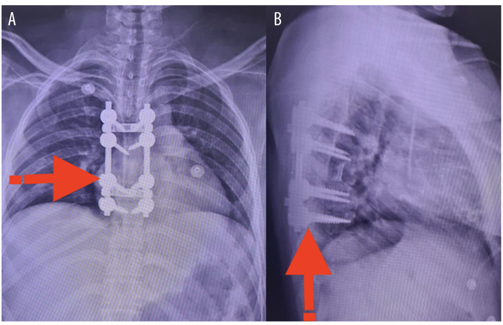 Post-operative X-ray images. (A). Rib graft in situ and posterior fixation. (B). Lateral mass screw fixation. * Red arrows point to the fixation locations.
