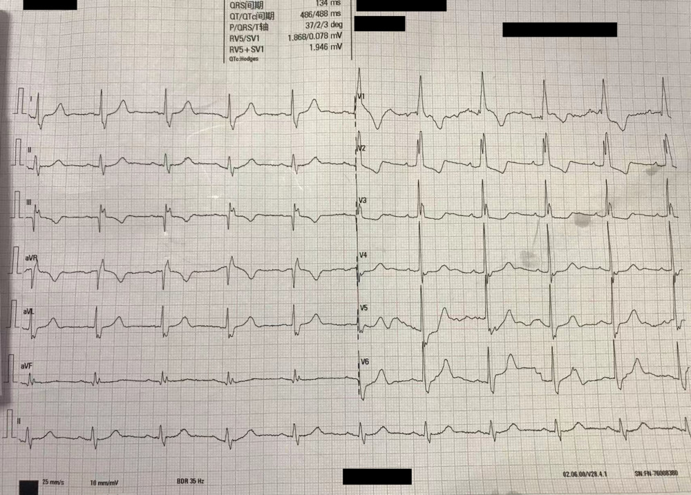 The electrocardiogram showed an old myocardial infarction.