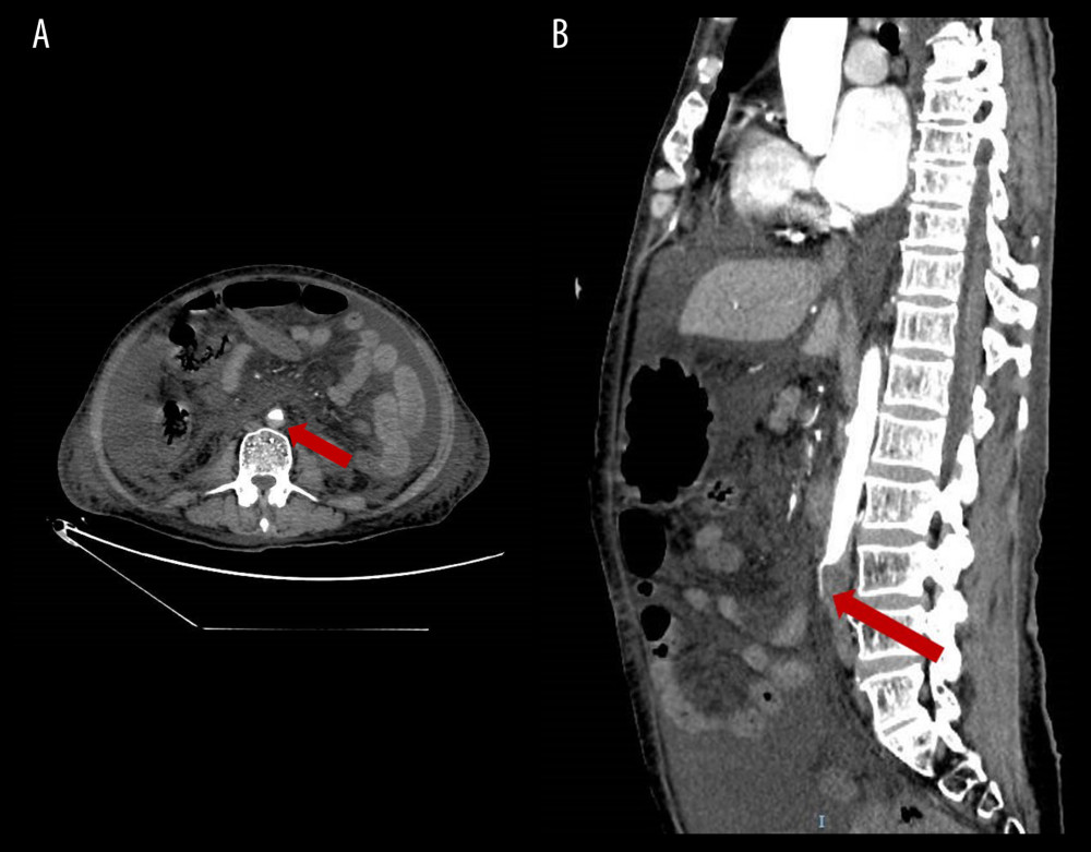 Visualized thrombus in the abdominal aorta (arrow) on computed tomography (CT) angiogram image. (A) Transverse view of CT angiogram. (B) Sagittal view of CT angiogram.