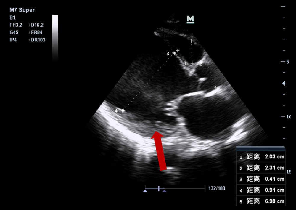 Echocardiography revealed a left ventricular mural thrombus.