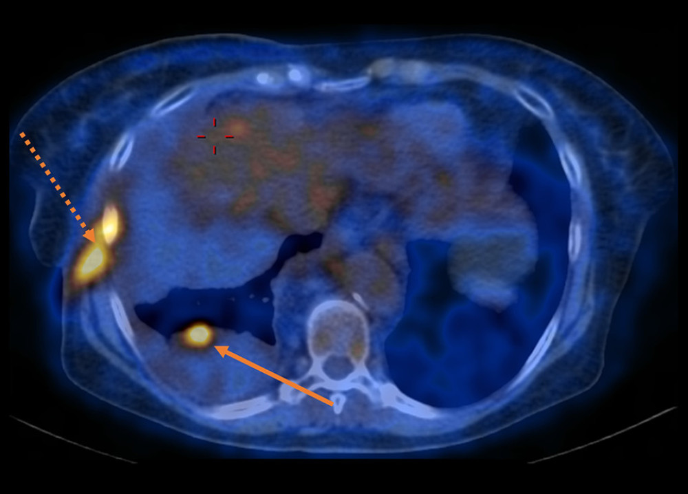 The first PET/CT scan demonstrating right-sided pleural effusion with increased metabolic activity in the lower lobe of the right lung (Deauville 4) (solid arrow), as well along the right lateral chest wall in the subcutaneous tissue (Deauville 4) (dotted arrow).