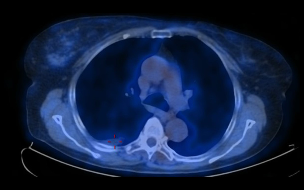 PET/CT scan after the 6th chemotherapy course, showing full metabolic remission (PET-negative) with minimal residual right-side pleural effusion.