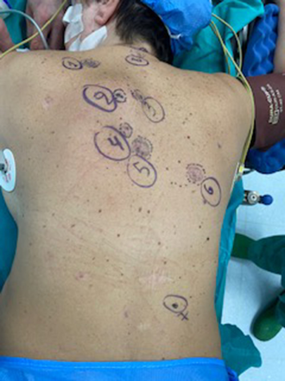 Preoperative photograph showing multiple pigmented skin lesions on the posterior trunk.