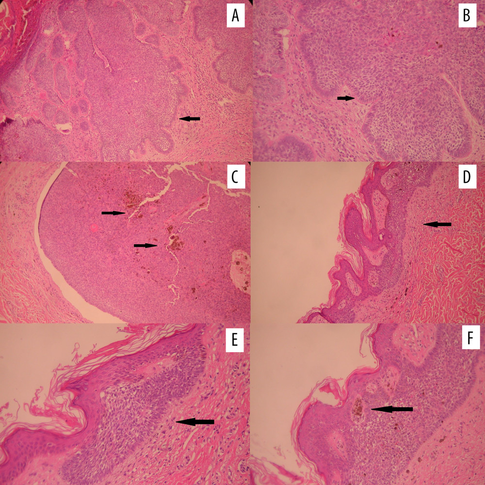 Histopathological images (A) Nodular basal cell carcinoma. Hematoxylin and eosin (H+E) ×100 and (B) Nodular basal cell carcinoma. Basaloid cells with palisading of the cells at the periphery of the nodule. H+E ×200 (C) Pigmented nodular basal cell carcinoma. H+E ×100 (D) Superficial basal cell carcinoma. H+E ×100 (E) Superficial basal cell carcinoma. Basaloid cells with palisading of the cells at the periphery. H+E ×200 (F) Pigmented superficial basal cell carcinoma. H+E ×200.