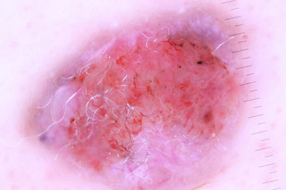 Dermoscopic features of the lesion: Blue-grey ovoid nests, central erosion, fine short and focused arborizing vessels, chrysalis lines, over a white-pink background. Diagnosis: basal cell carcinoma.