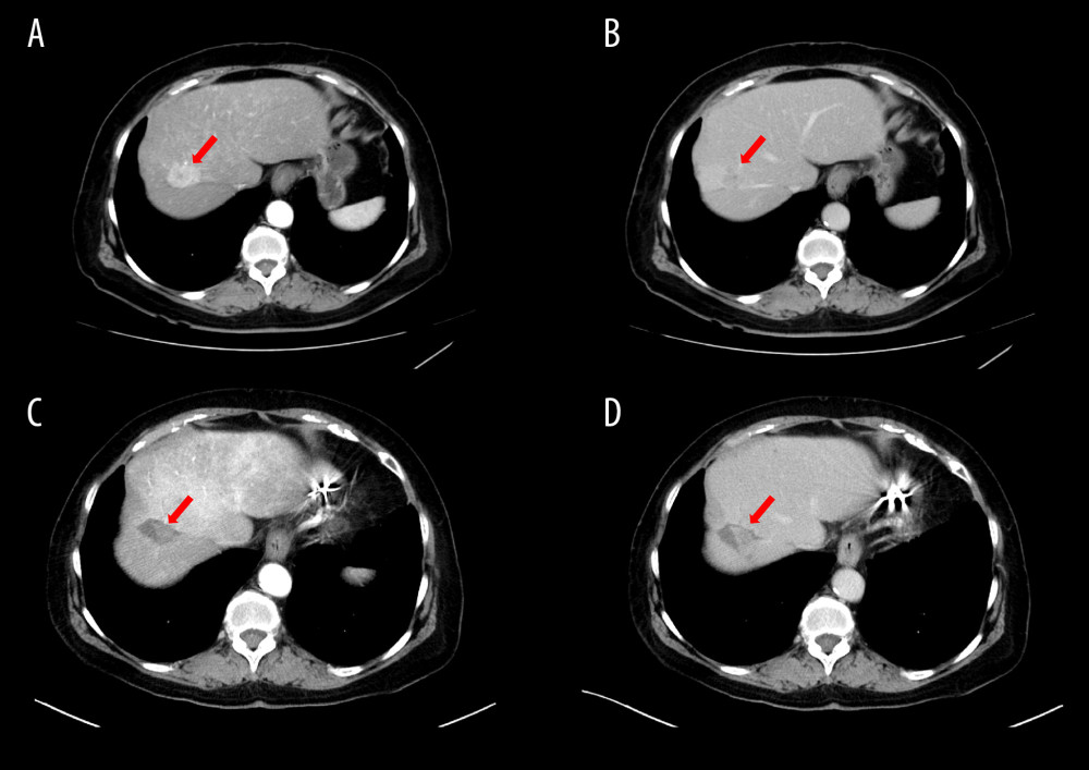 Contrast-enhanced computed tomography (CT) 4 years before radiofrequency ablation (RFA), showing a tumor (red arrow) in the liver S8 (A) enhancement in the early phase and (B) washout in the late phase. (C, D) Contrast-enhanced CT showing nodules (red arrow) inside the low-absorption zone of the previously treated area of RFA.