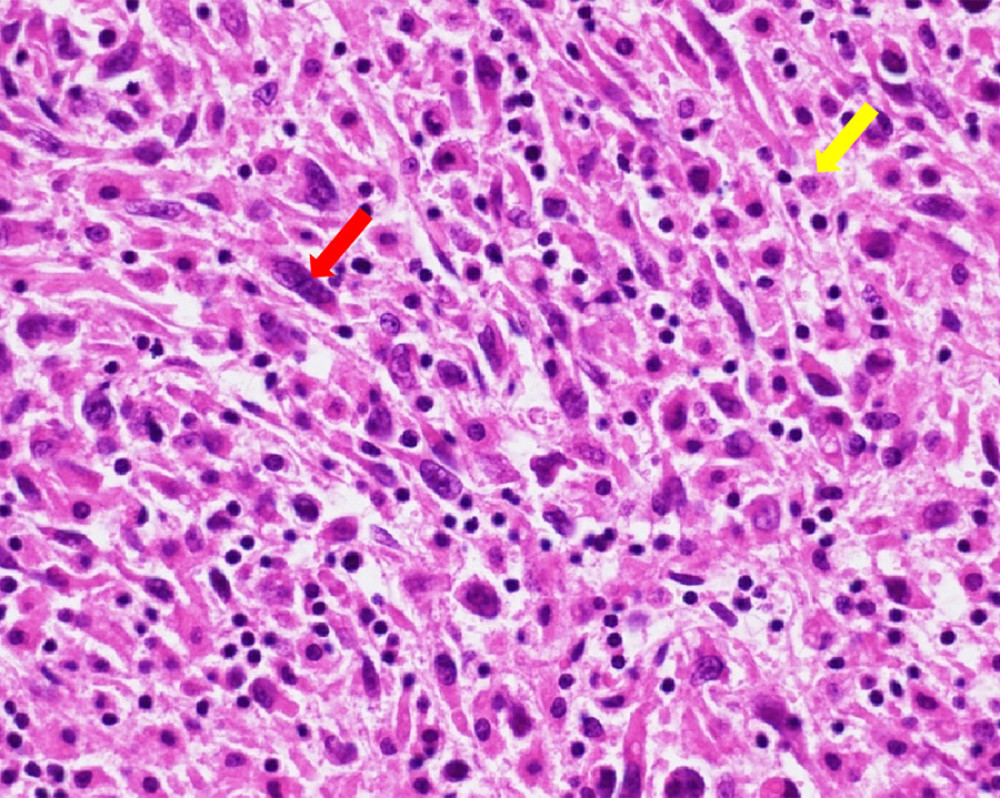 Hematoxylin and eosin staining of cancerous specimens showing spindle-shaped tumor cells (red arrow) and actively mitotic cells (yellow arrow).