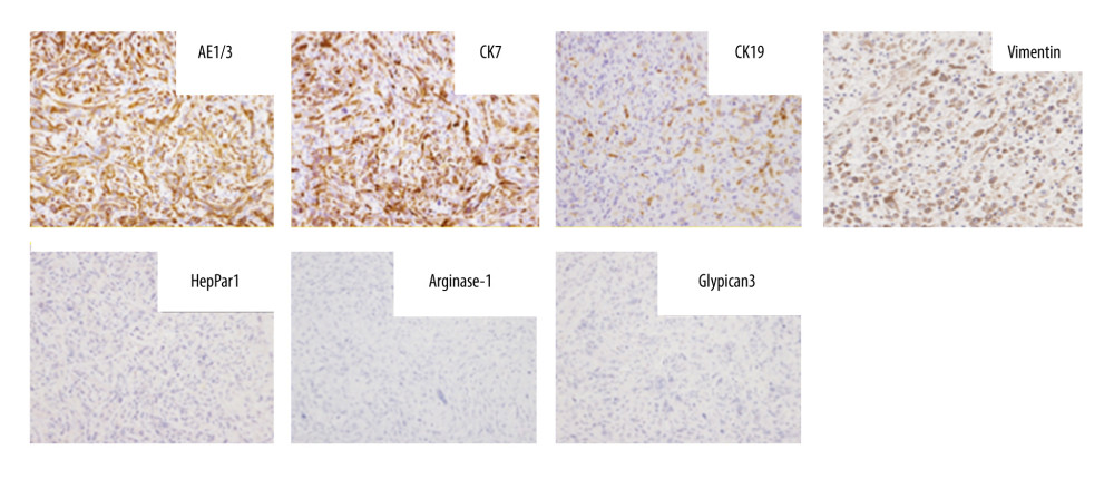 Immunohistochemical staining showing positive AE1/AE3, CK7, and vimentin; positive CK19 (in some cells); and negative HepPar1, Arginase-1, and Glypican3.
