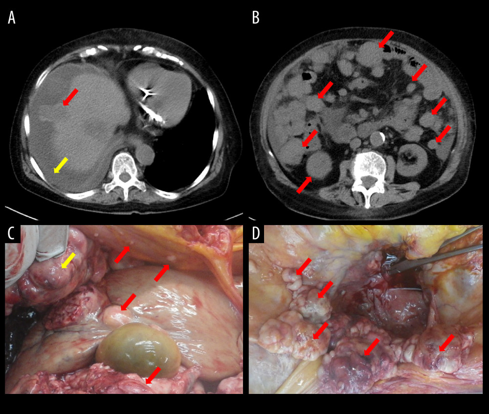 (A) Simple computed tomography (CT) showing a prominent mass (red arrow) in hepatic S8 and ascites (yellow arrow) with high CT values. (B) Simple CT showing numerous disseminated lesions (red arrows) in the abdominal cavity. (C, D) In the diaphragm, numerous lumpy tumors (red arrows) and disseminated nodules (red arrows) up to 13 cm in size, adherent to the right lobe capsule of the liver, are observed. A 3-cm large mass (yellow arrow) that is exposed on the surface of the liver S8 is observed. A clot is also observed near the right subdiaphragm. The ascites appeared pale and bloody and was an amount of 3300 mL, but the source of the hemorrhage was unknown.