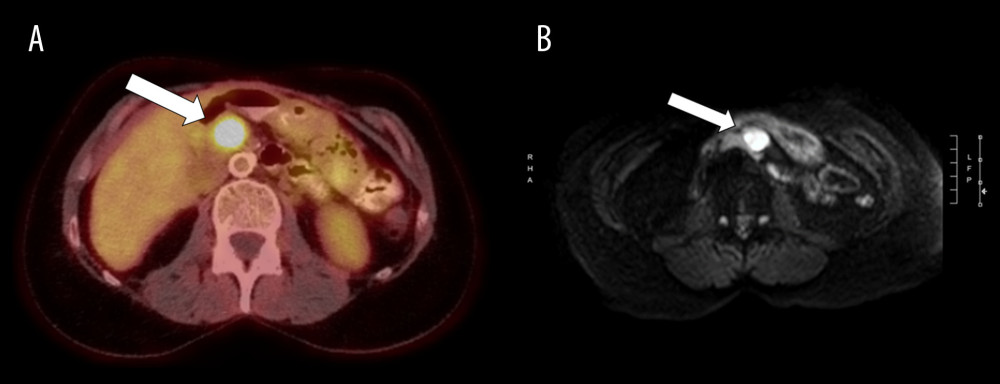 (A) Select image from the fluorodeoxyglucose (FDG)-positron emission tomography demonstrating an FDG-avid mass in the location of the superior mesenteric vein (arrow). (B) Magnetic resonance diffusion-weighted image showing a mass in the superior mesenteric vein (arrow) with restricted diffusion, obtained with a 1.5 Tesa magnet.