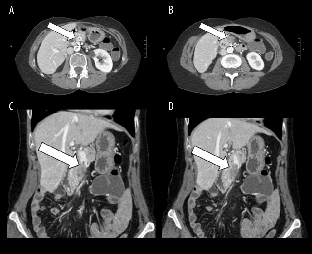 Images from the venous phase of a multiphasic computed tomography scan abdomen demonstrating a 3.5-cm tumor in the superior mesenteric vein. The arrow in each image indicates the location of the tumor. Sagittal images (A, B), coronal images (C, D) are presented.