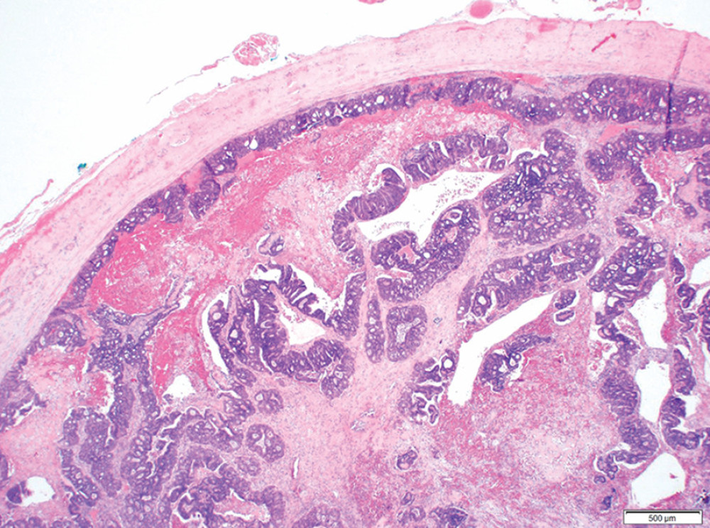 Photomicrograph of the resected superior mesenteric vein with a tumor thrombus. The metastatic colonic adenocarcinoma fills the lumen of the vein (asterisk marks vein wall), and it is composed of anastomosing neoplastic tubules with dirty necrosis (arrow). Scattered thin-walled vessels (letter v) are present, consistent with recanalization. Hematoxylin and eosin stain, 20× magnification, scale bar indicates 500 μm.
