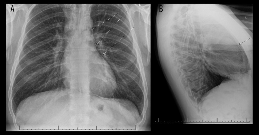 Chest X-ray of (A) posterior to anterior and (B) lateral views. Arrows indicate an area of lucency along the cardiac border indicating pneumomediastinum.