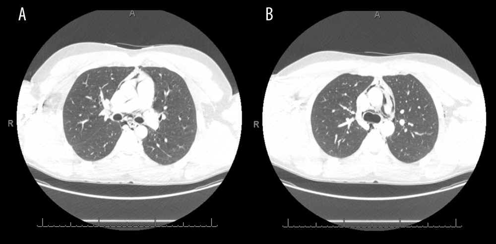 Computerized tomography of the chest. (A, B) The presence of air is visible around the mediastinal structures, indicating pneumomediastinum.