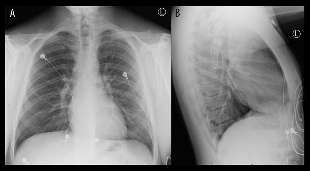 Repeat chest X-ray (A) posterior to anterior and (B) lateral views. There is improvement in pneumomediastinum when compared with the initial imaging.