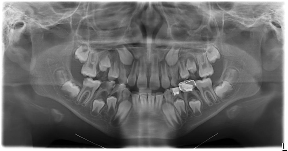 Panoramic radiograph. The panoramic radiograph reveals the presence of a unilateral bi-rooted upper left primary canine.