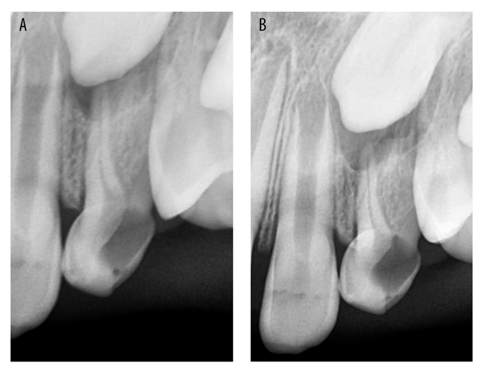 Periapical radiographs. (A) Periapical radiograph of the upper left primary canine, showing the 2 roots. (B) Periapical radiograph of the upper left primary canine; applying mesial shift confirmed the presence of 2 roots.