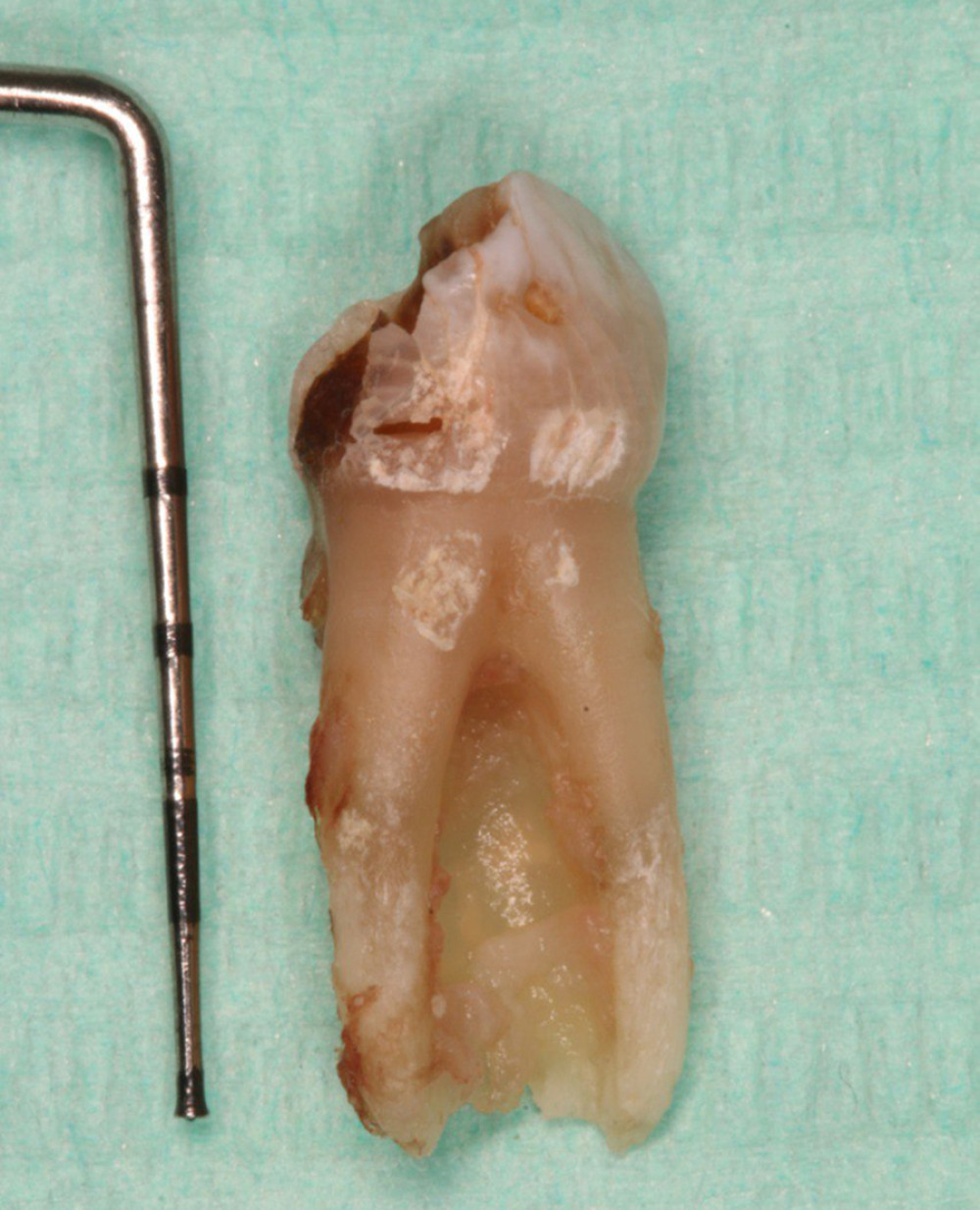 The facial aspect of the upper left primary canine after extraction.