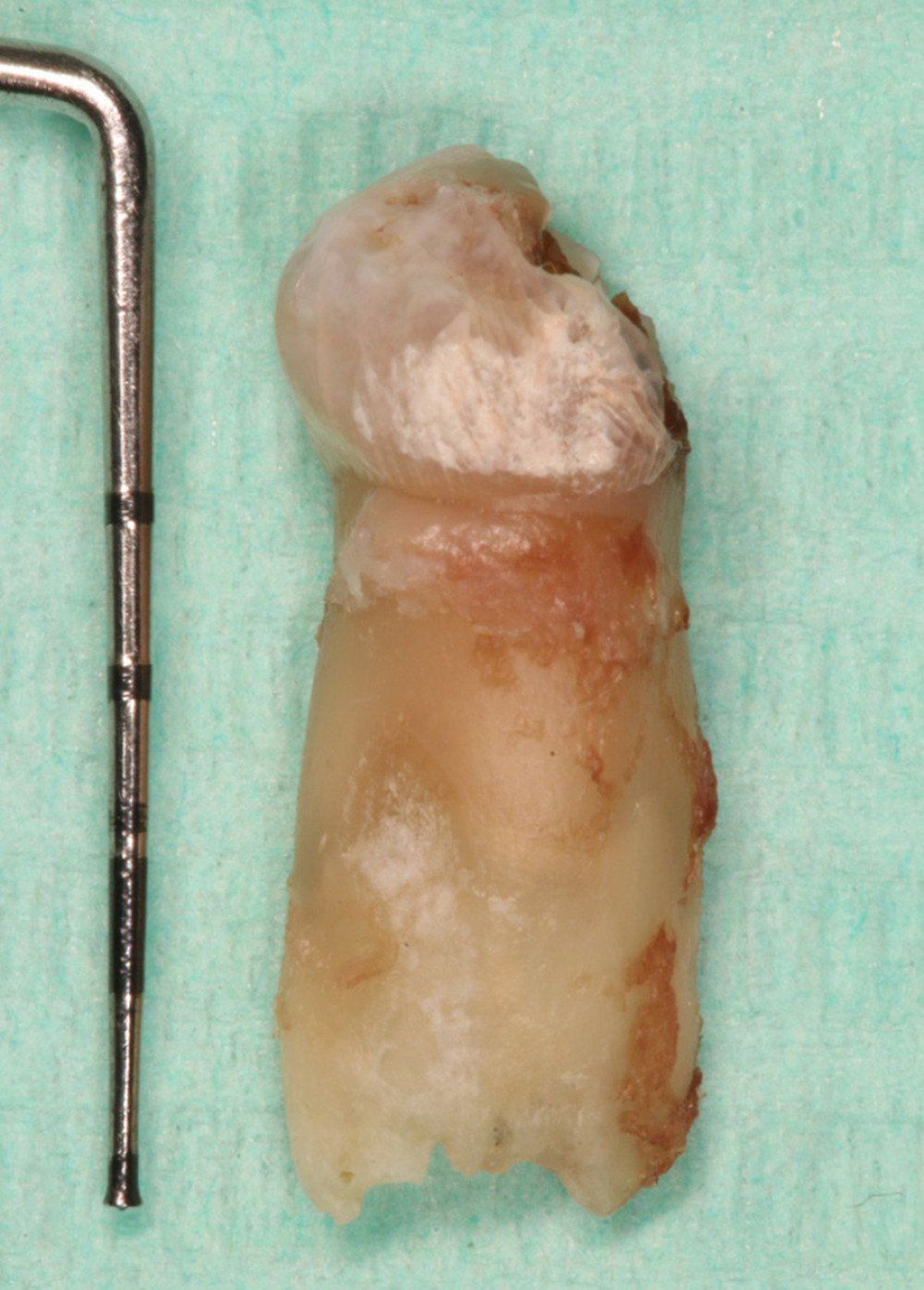 The palatal aspect of the upper left primary canine after extraction.