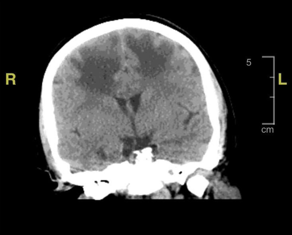 Brain computed tomography. Intraparenchymal masses were noted in both frontal lobes and were associated with extensive surrounding parenchymal edema. The right frontal lobe mass measured 1.9×2 cm. Left frontal lobe mass measured 1.5×1.6 cm. There was no obvious midline shift, other discrete masses, parenchymal edema, or intracranial hemorrhage. There was no evidence of transtentorial or uncal herniation. The ventricles and the deep cisterns were normal.