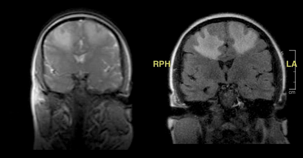 Magnetic resonance imaging of the brain with and without contrast. There are 2 enhancing lesions seen in the right and left posterior frontal aspect of the brain. There can also be seen moderate vasogenic edema surrounding the lesions. Mild diffusion restriction is noted at the periphery of these masses. There is no associated hemorrhage. No additional lesions are seen. The brain otherwise appears to be of normal volume and formation, without midline shift, herniation, or hydrocephalus.