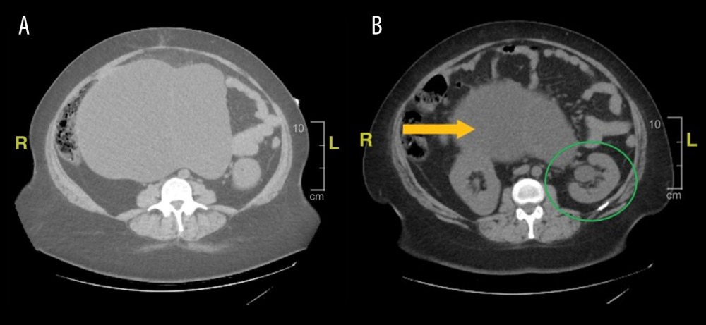 (A) Computed tomography of the abdomen and pelvis. In the pelvis, a midline complex and mostly cystic lesion is indicated by the yellow arrow. Septations and soft tissue components were noted of the lesion that is 25 cm in approximate diameter and appears to arise from the left ovary. The uterus is grossly unremarkable but somewhat distorted in appearance. The right ovary was not seen. The left and right colon is compressed but otherwise unremarkable. The appendix is unremarkable. The urinary bladder is not distended or inflamed. There are no hernias. (B) The green circle encloses the left hydronephrosis of the left kidney.