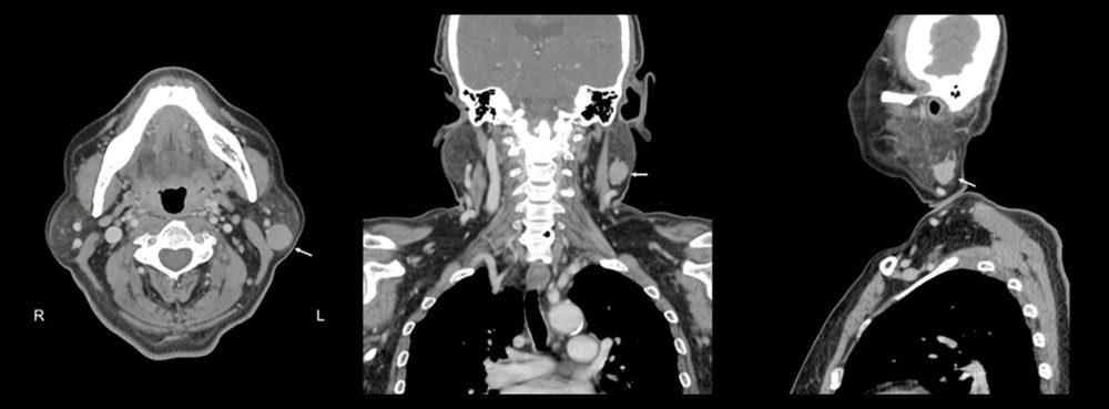 Preserved bilateral parotid and submandibular glands, but a suspicious mass lesion, measuring18×16×13 mm (arrow), was seen in the tail of the left parotid gland.