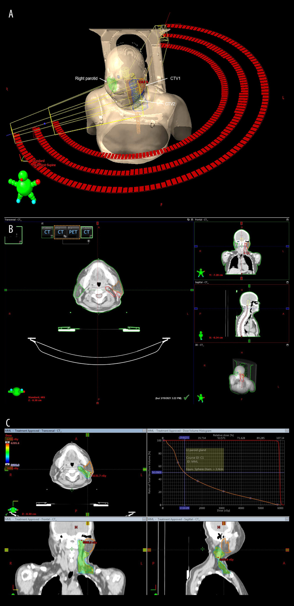(A) CTV including the left parotid tumor bed and left neck lymph nodes at levels IB, II, III, IV, VA, and VB. (B) Axial CT slices with CTV in redline, and organ at risk with remaining left parotid gland in orange line, right parotid gland in green line. (C) Dose distribution in colorwash and dose-volume histogram.