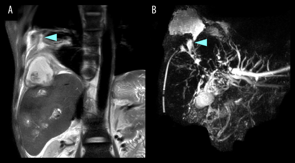 (A) Coronal view of abdominal magnetic resonance imaging (MRI) showing multiple liver abscesses and the formation of a lung abscess in the right lower lobe, accompanied by pleural effusion accumulation. (B) Magnetic resonance cholangiopancreatography highlights the supra-phrenic accumulation of bile and its visible communication with the biliary system (arrow).