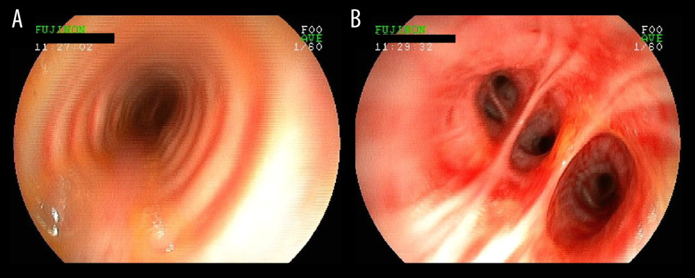(A) Bronchoscopic image displaying the bronchial entrances, and (B) the right middle and lower lobe, exhibiting reddish luminal mucosa and the presence of gushing yellowish fluids (December, 2019).