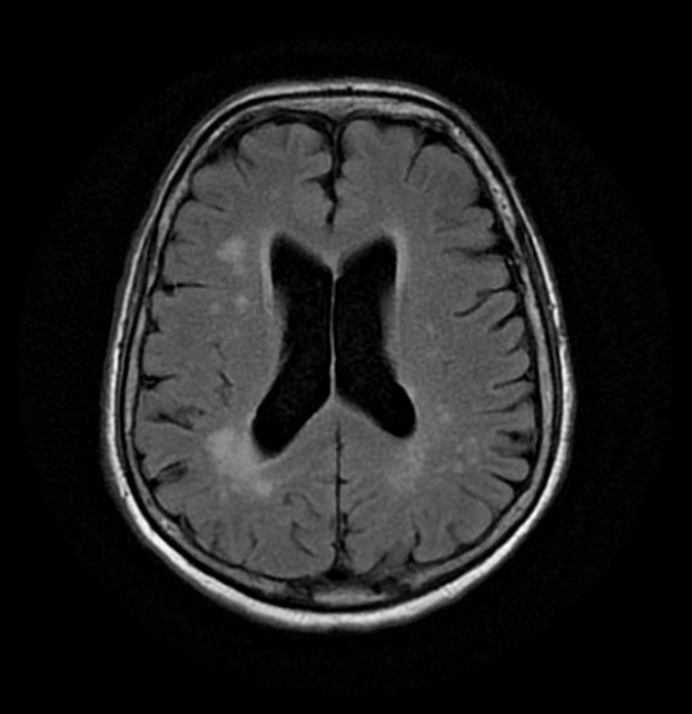 Magnetic resonance imaging of brain with interpretation on day 1 of hospitalization. No regions of restricted diffusion. No acute infarcts. Intracranial magnetic resonance angiography negative and unchanged from prior computed tomography. There are mild/moderate nonspecific white matter changes in the periventricular white matter of both cerebral hemispheres compatible with small vessel ischemic disease or age-related degenerative change.