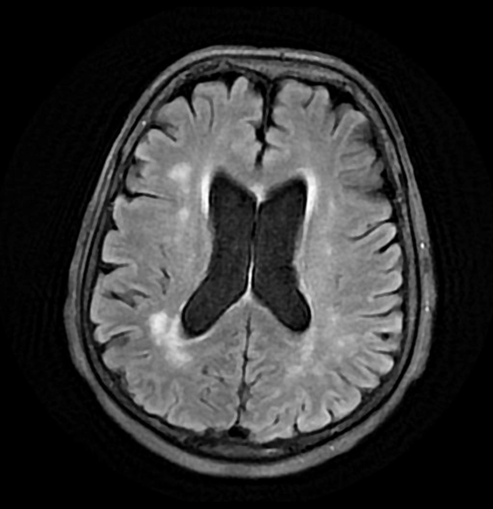 Magnetic resonance imaging of brain with interpretation on day 11 of hospitalization. No acute intracranial abnormality. Moderate leukoaraiosis. Mild cerebral and cerebellar volume loss.
