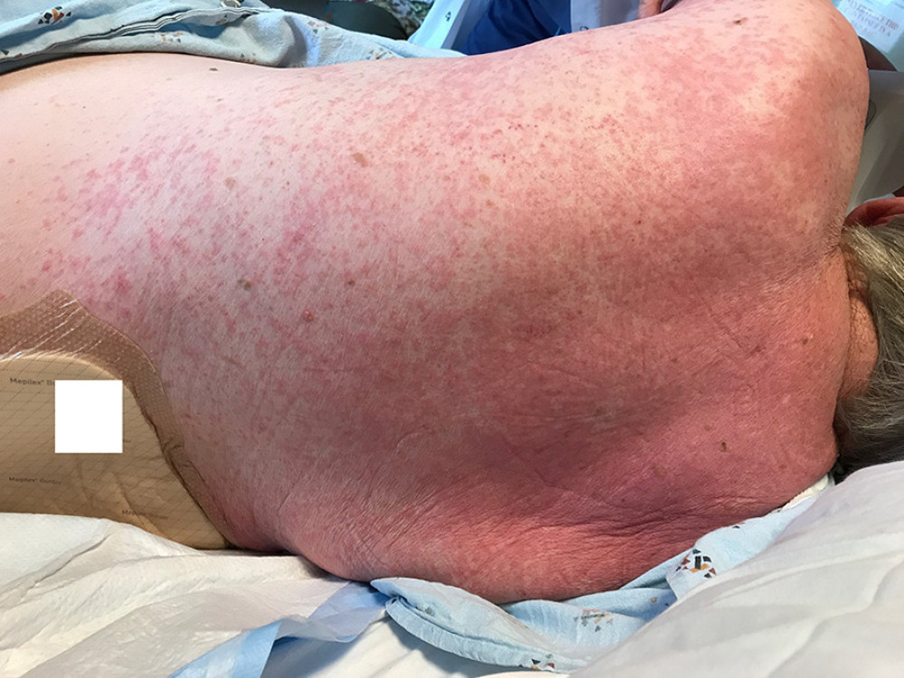 Jarisch Herxheimer reaction after ceftriaxone administration. Rash resumed after a few days upon cessation of ceftriaxone.