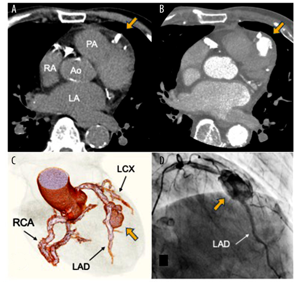 Preoperative plain and contrast CT findings and coronary angiography. Coronary artery pseudoaneurysm (arrow) was absent on computed tomography (CT) on admission (A) but appeared on contrast-enhanced CT 21 days after admission (B). It was also obvious in the left anterior descending artery on three-dimensional CT (C) and coronary angiography (D). Ao – aorta; LA – left atrium; LAD – left anterior descending artery; LCX – left circumflex artery; PA – pulmonary artery; RA – right atrium; RCA – right coronary artery.