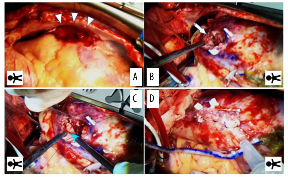 Intraoperative findings. The pseudoaneurysm wall was adherent to the pericardium (A, arrowhead). When the pseudoaneurysm was incised, the coronary artery intima was highly calcified and completely ruptured on the proximal side of the pseudoaneurysm (B, arrow). After endarterectomy (C), the aneurysm wall was closed (D).