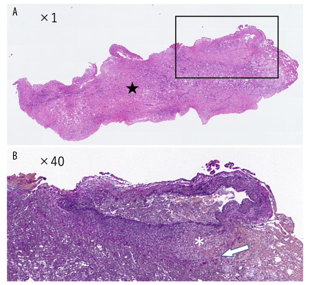 Pathological findings. (A) (Hematoxylin and eosin stain ×1): Edematous fibrosis and mild lymphocytic infiltration were observed in the adipose tissue surrounding the coronary artery (star). The area outlined by the rectangle is enlarged and shown in (B). (B) (Elastica van Gieson stain ×40): Elastic fibers were broken and lost in part of the tunica media of the coronary artery. The external elastic lamina was also lost (arrows). The resulting coronary artery wall was swollen (asterisk). No bacterial or neutrophilic infiltration nor any obvious signs of infection were evident.