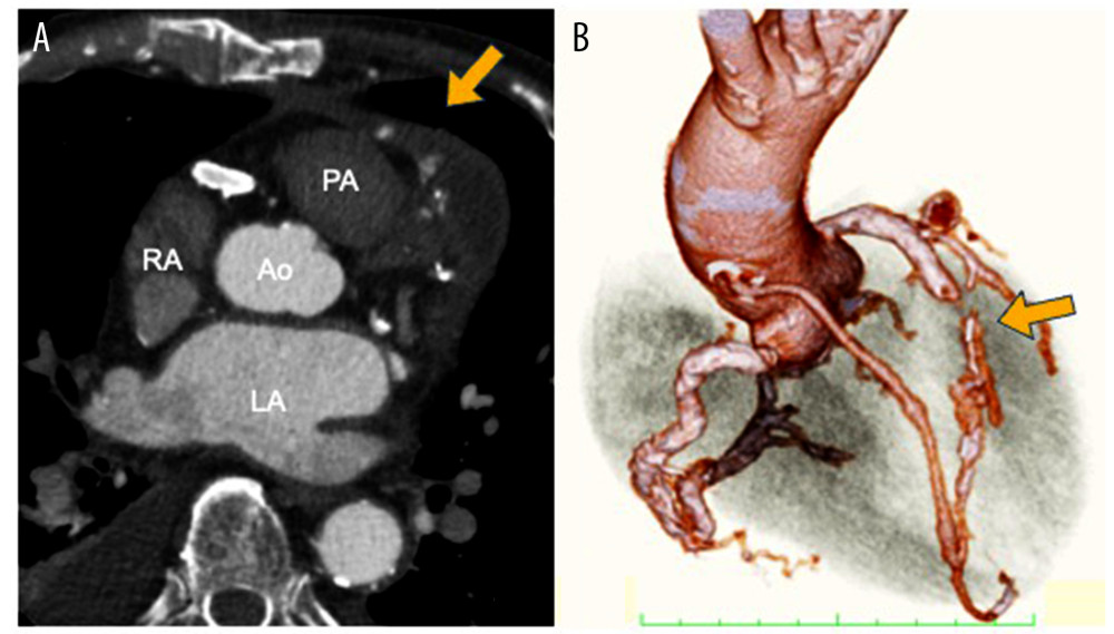Postoperative CT findings two months after surgery. Coronary angiographic computed tomography (CT) shows the patency of the bypass graft to the LAD and no pseudoaneurysm recurrence (arrows) (A: horizontal section; B: three-dimensional-CT). Ao – aorta; LA – left atrium; PA – pulmonary artery; RA – right atrium.