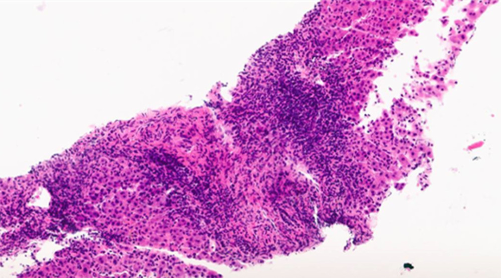 Liver biopsy showing acute inflammation with lymphocytes predominance (hematoxylin and eosin staining).