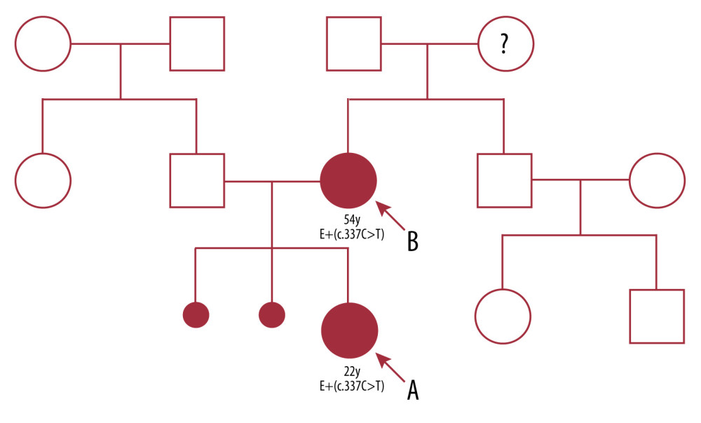 Family tree. A) The proband (case 1). B) The proband’s mother (case 2). E=nonsense variant NM_017730.3: c.337C>T; p.(Gln113*).