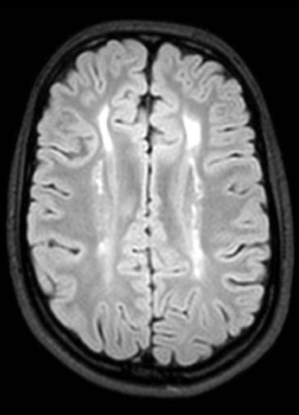 The proband’s magnetic resonance imaging showing periventricular symmetric transverse relaxation time (T2) and fluid-attenuated inversion recovery (FLAIR) hyperintense white matter lesions in both hemispheres.