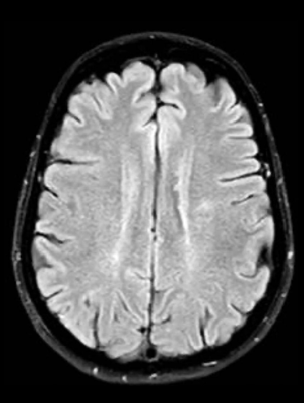 Magnetic resonance imaging of the proband’s mother showing the absence of any specific brain matter lesions.