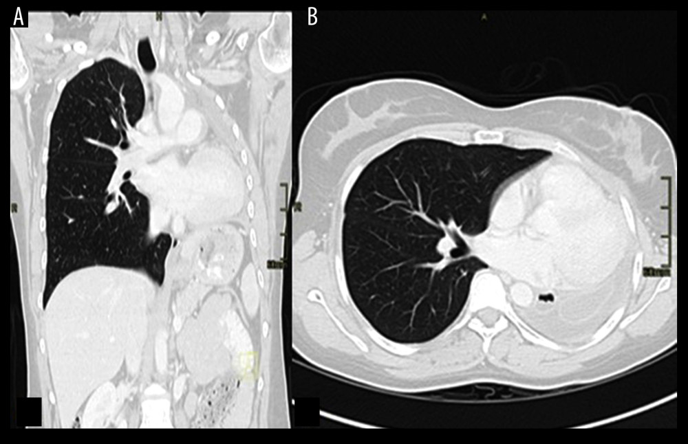 A coronal (A) and cross-sectional (B) computed tomography scans without contrast at 19 weeks of gestation revealing no signs of recurrence or metastasis.