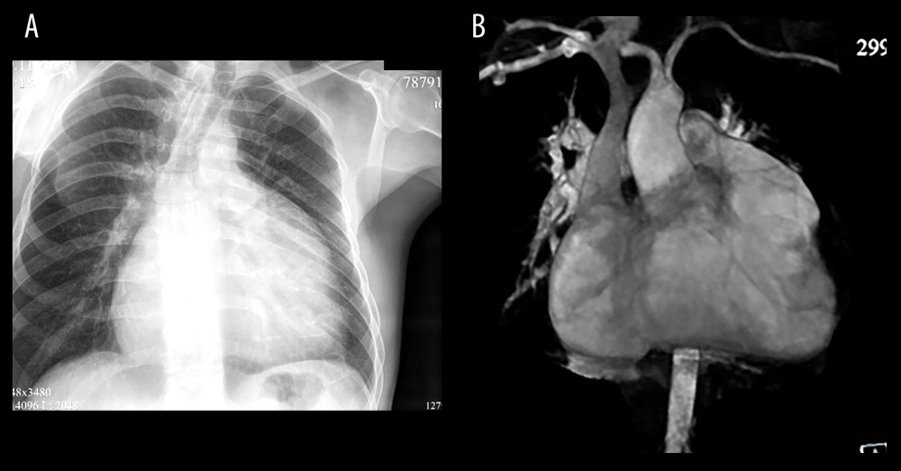 (A, B) Chest X-ray and MR-angiography of patient 1. Severe cardiomegaly with right chambers dilatation is noted.