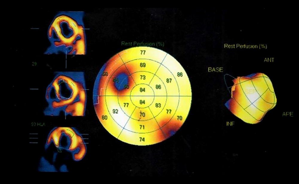 Positron emission tomography of patient 2. Uniform distribution of radioisotopes in systemic ventricle’s myocardium except for a 5% zone near the apex and ventricular septum.