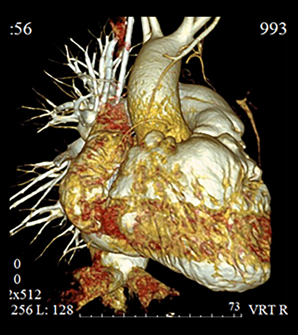 CT-angiography of patient 3. Right chambers are dilatated and single right pulmonary artery is noted.
