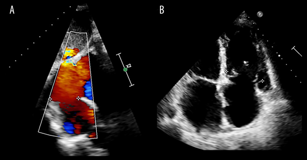 (A, B) Echocardiography of patient 5. Large ASD without an inferior rim and four-chambers view with right heart dilatation.