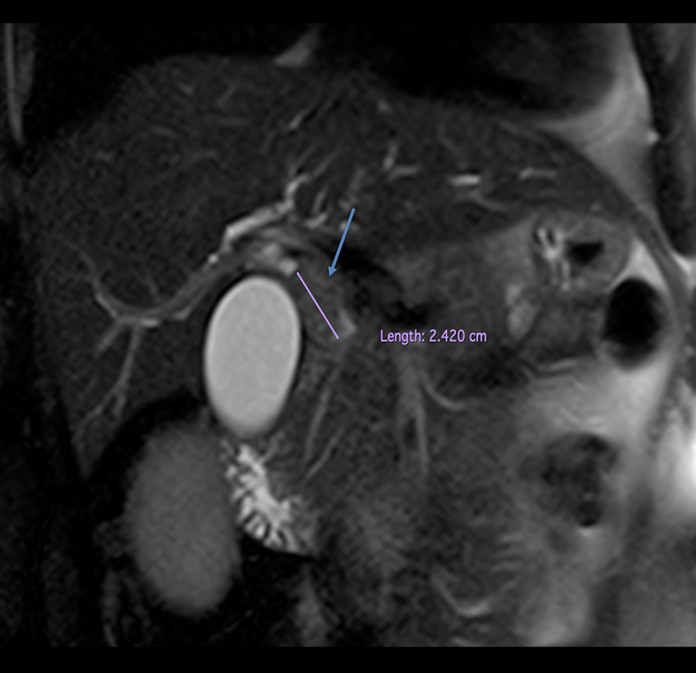 Magnetic resonance imaging of the hepatobiliary system shows an unclear hypovascular formation of 2.5×2 cm in the contact area of the ductus cysticus and ductus hepaticocholedochus.