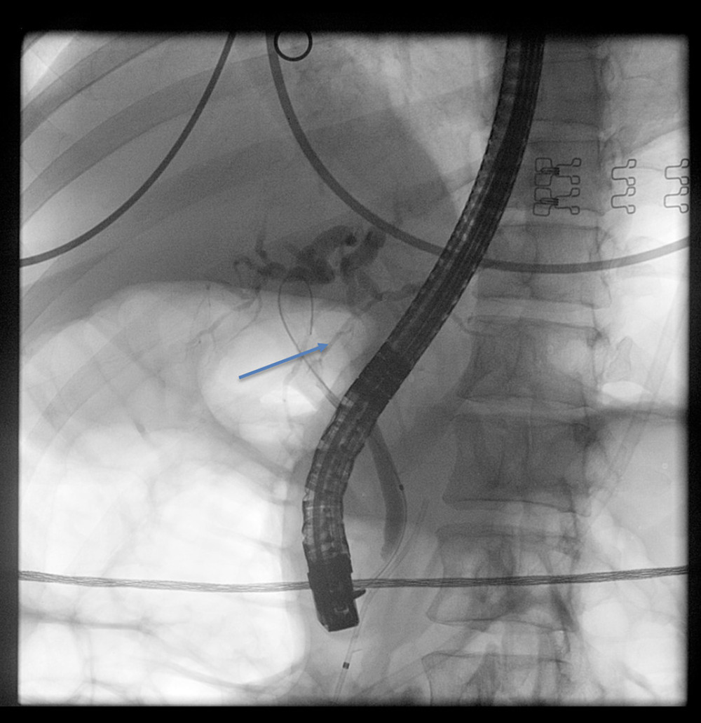 Endoscopic retrograde cholangiopancreatography cannulation shows that the ductus hepaticocholedochus proximal part has a 25-mm-long stricture, above which dilated intrahepatic ducts are seen.