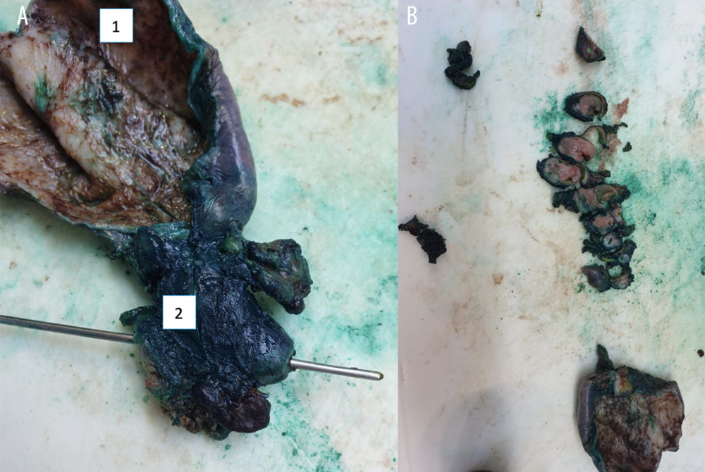 Macroscopically, the ductus choledochus is filled with a yellowish tumor 3×2×2 cm spreading into the ductus cysticus: (A) gallbladder (1); ductus cysticus with a probe in it (2); (B) tumor mass within the ductus cysticus.